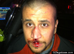 George Zimmerman Bloody Face Photo