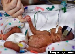 Journalist Reveals Heart-Wrenching Tale Of Having A Micro-Preemie