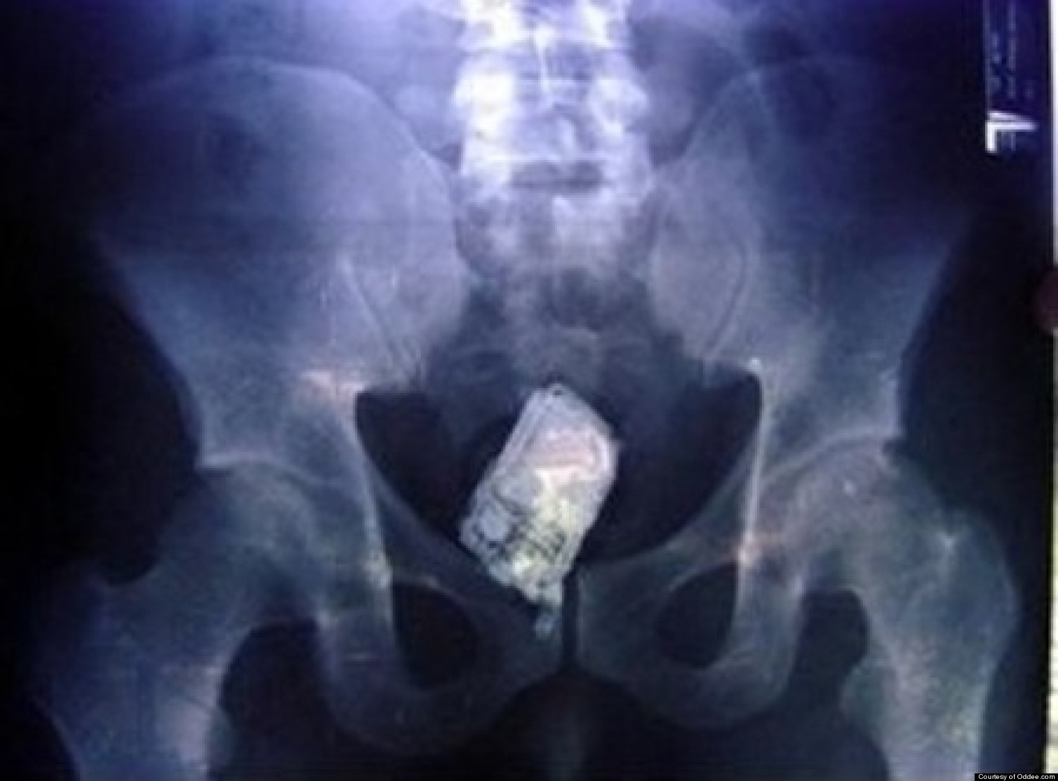 Crazy Things Stuck In Rectum Nsfw Huffpost