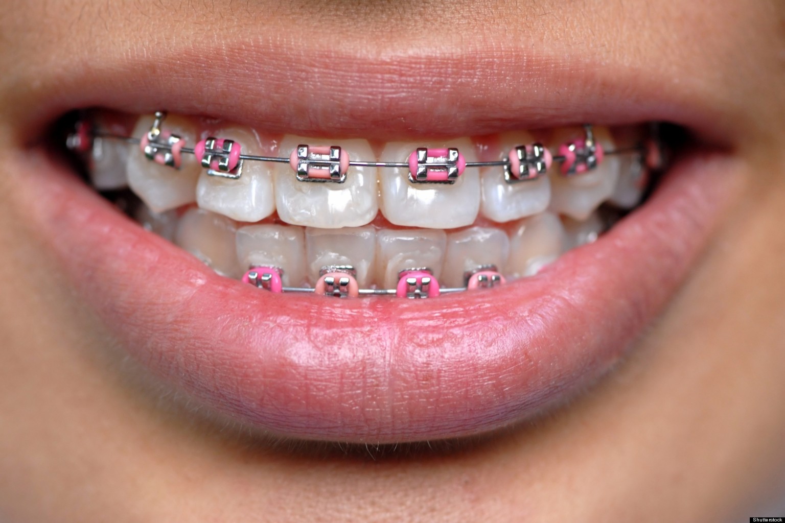 Gungahlin Orthodontist