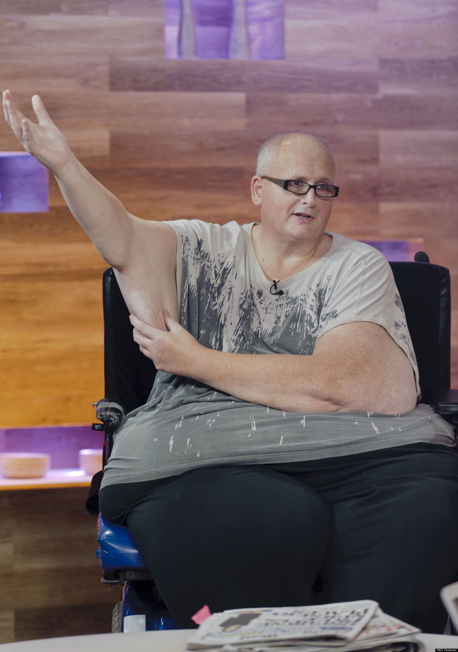 World s Fattest Man Loses 46 Stone And Needs Surgery To Remove Loose 