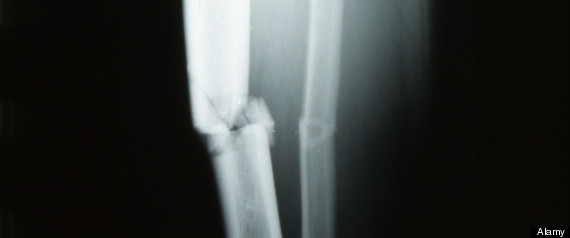 Fracture