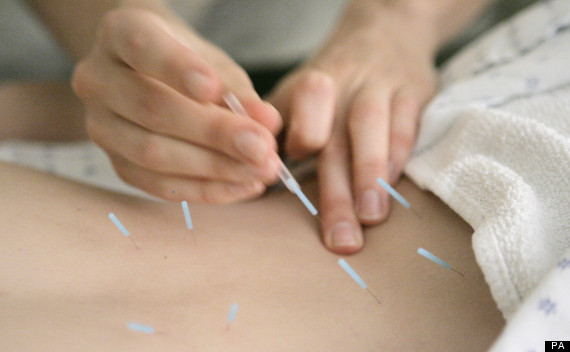 Acupuncture