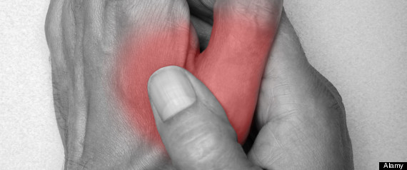 Arthritis