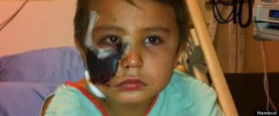 Dog Attack Boy Face