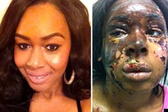 naomi oni acid attack victim