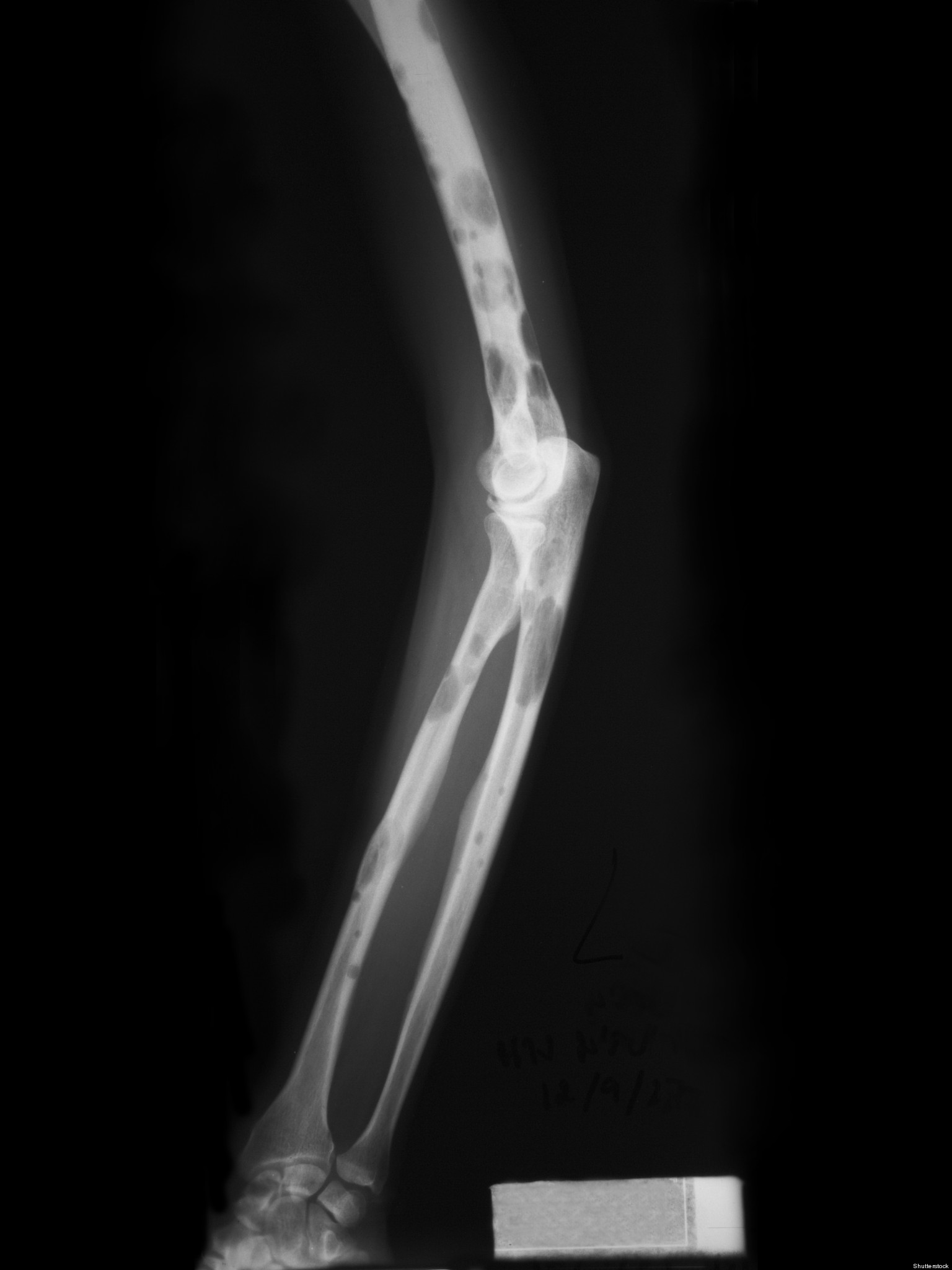 Cortisone The End of an Era HuffPost