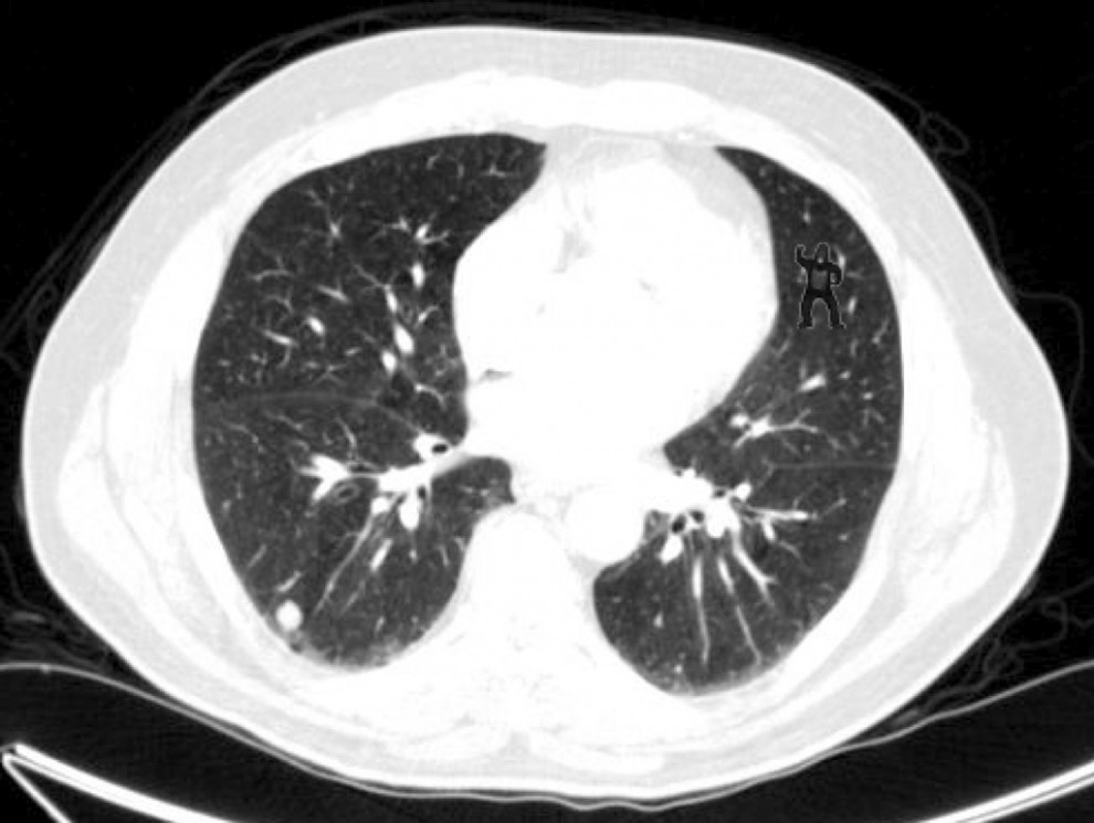 Lung+ct+scan+images
