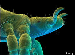 Rare, Dangerous Body Lice Outbreak In Edmonton