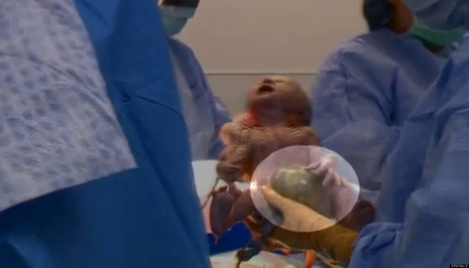 Hayden Hoskins, Baby Born With Omphalocele, Survives Despite Organs