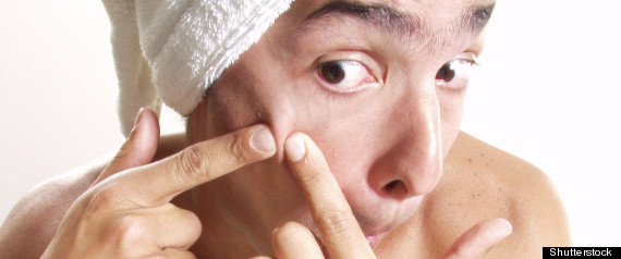 Pimple Popping: Acne, Blisters And Scabs -- 9 Things You Shouldn't Pop