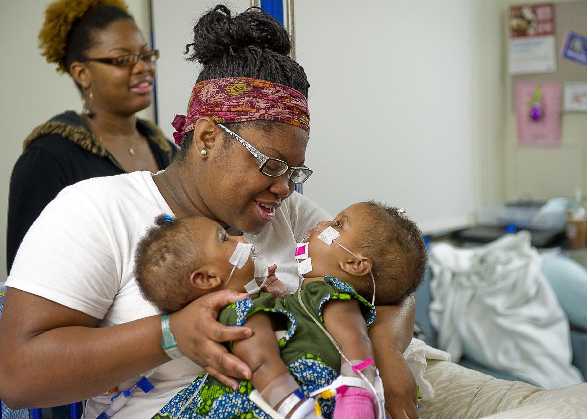 Conjoined Twins A'zhari & A'zhiah Jones Separated In Rare 'Phased ...