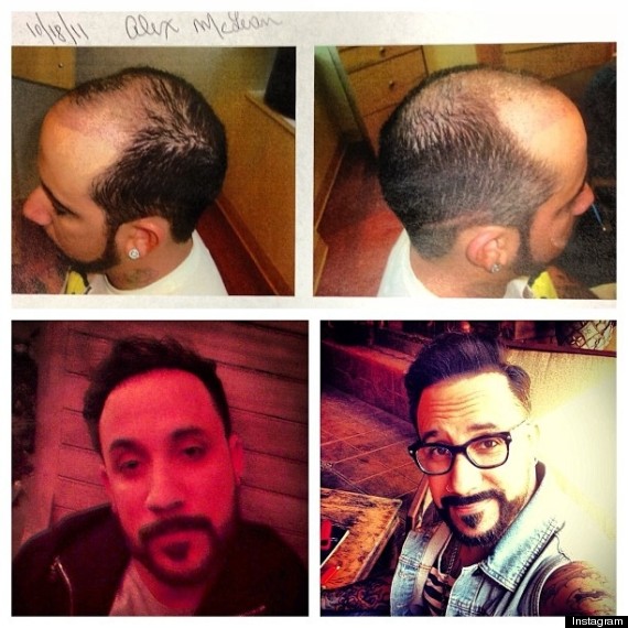 aj mclean hair plugs