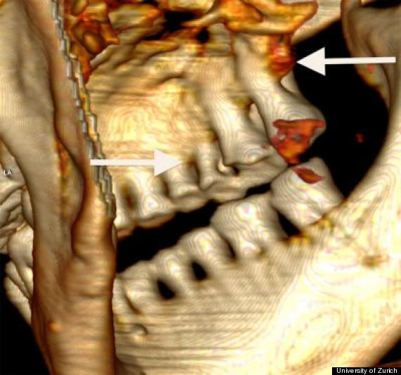 otzi teeth