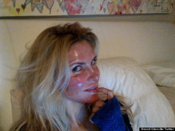 brandi glanville burned face