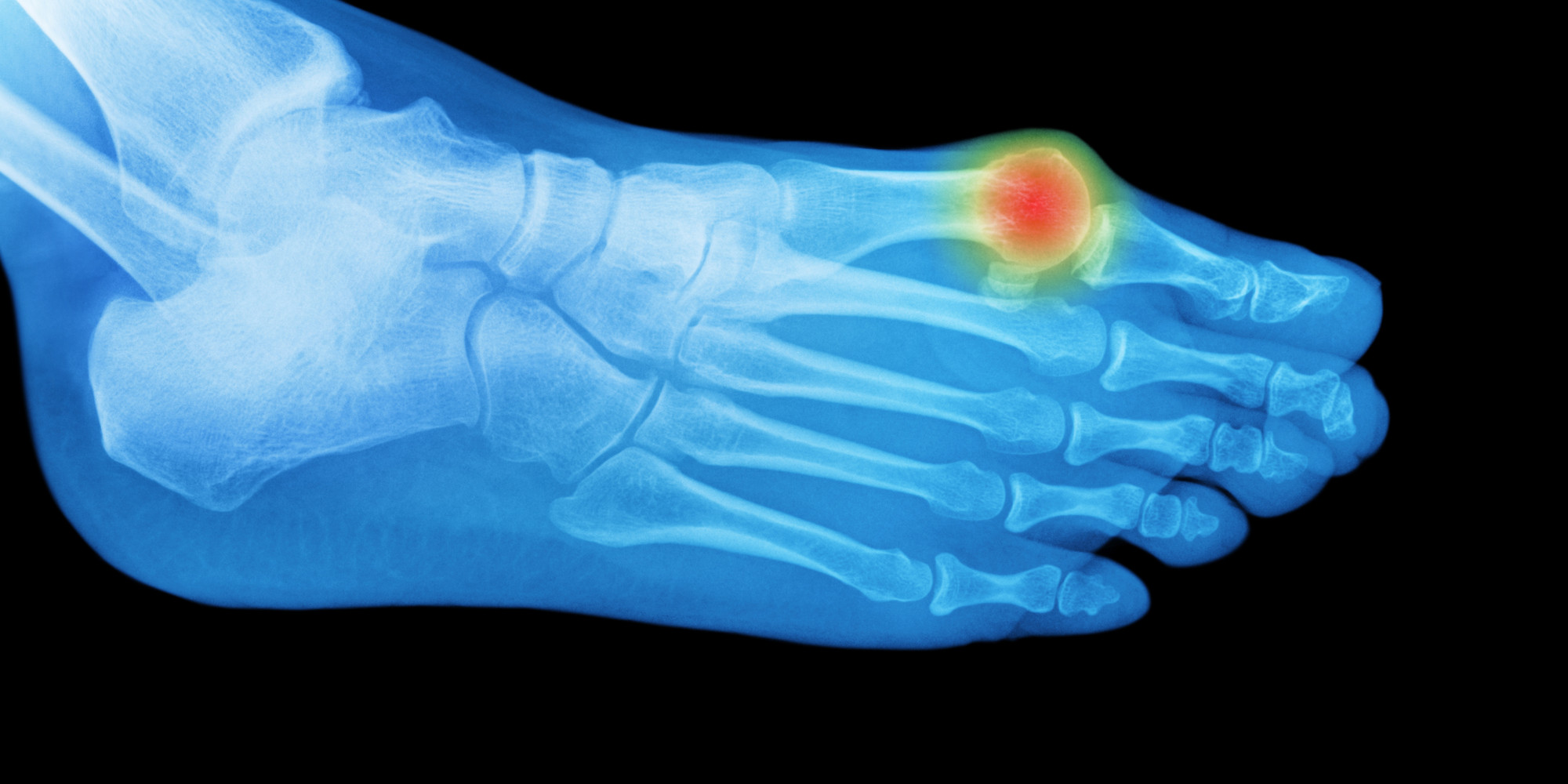Bunions May Be Hereditary, Study Finds