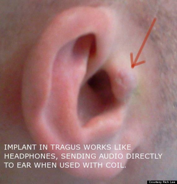 earbud implant
