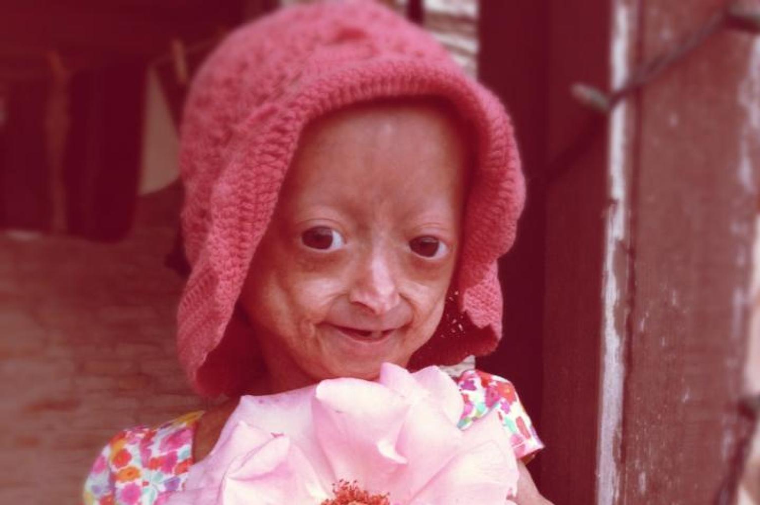 Adalia Rose, 6-Year-Old With Premature Aging, Promotes Fundraiser For ...