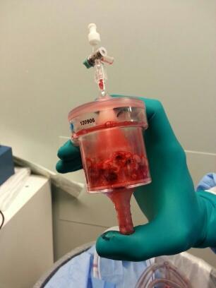 blood clot 1