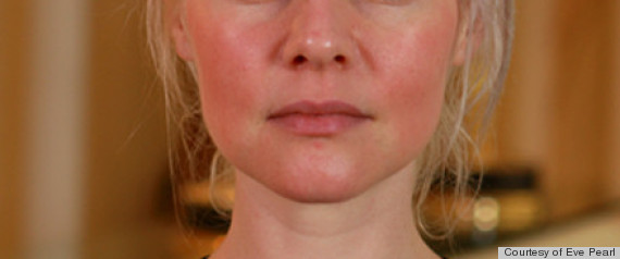 rosacea makeup