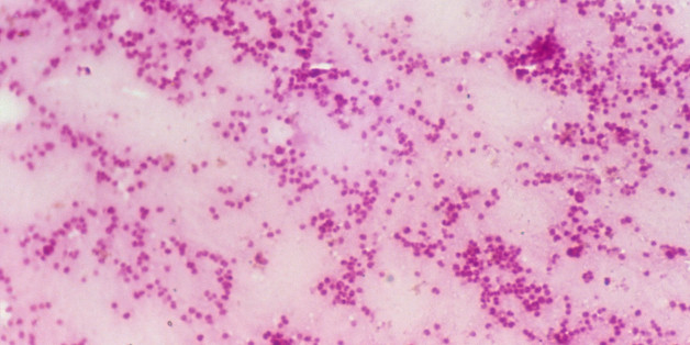 Gonorrhea, Syphilis Increasing In The US, STD Report Shows | HuffPost