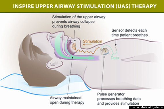 sleep apnea treatment