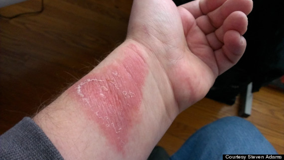 Some Force Complain Of Severe Skin | HuffPost Impact