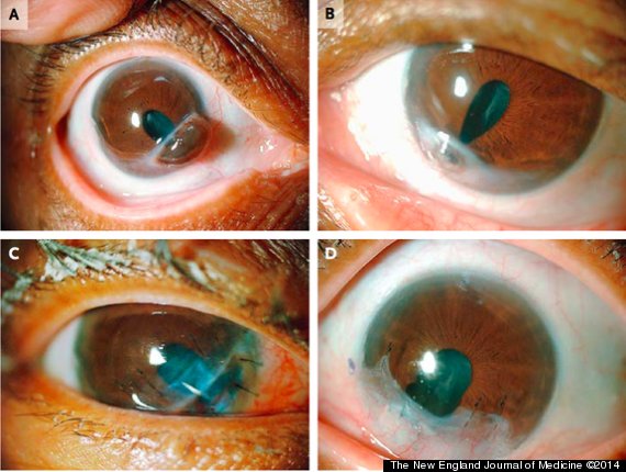 corneal melt