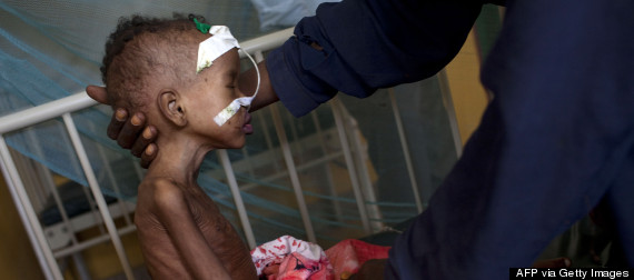 somalia malnutrition