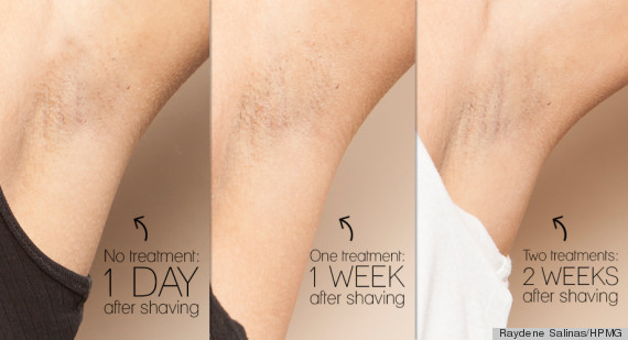 Why Laser Hair Removal Just Might Be Worth Every Penny HuffPost Life