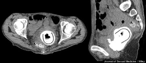 sex toy xray