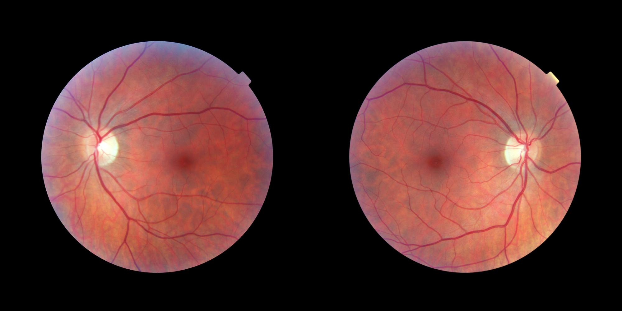 Недоразвитая сетчатка глаза. Диабетическая ретинопатия. Ретинопатия недоношенных. Опухоли зрительного нерва глазное дно.