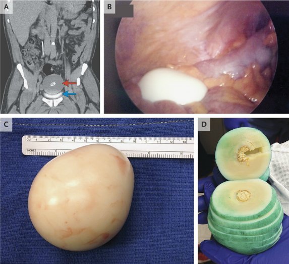 peritoneal loose body