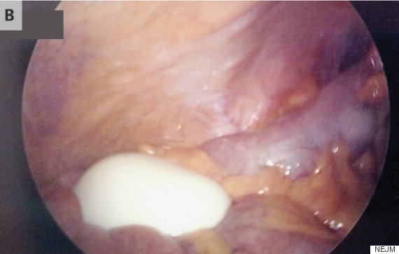 peritoneal loose body