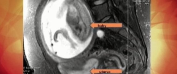 Outside Of Uterus Muscles Diagram