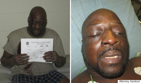 floyd dent injuries