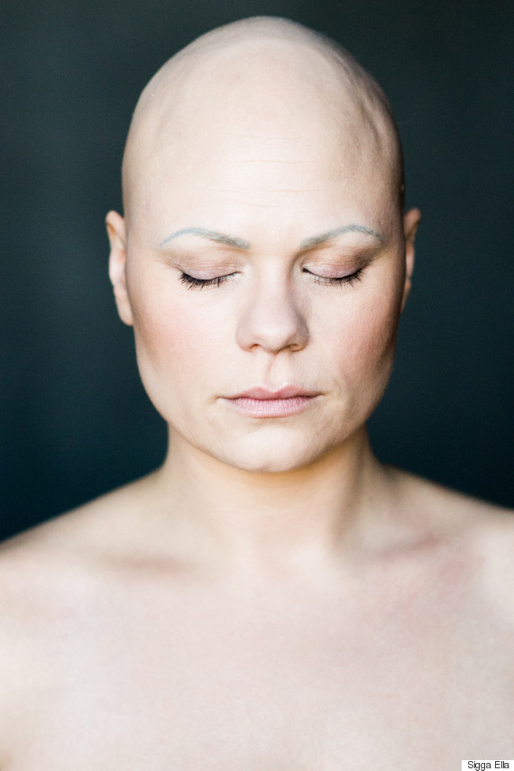 alopecia2