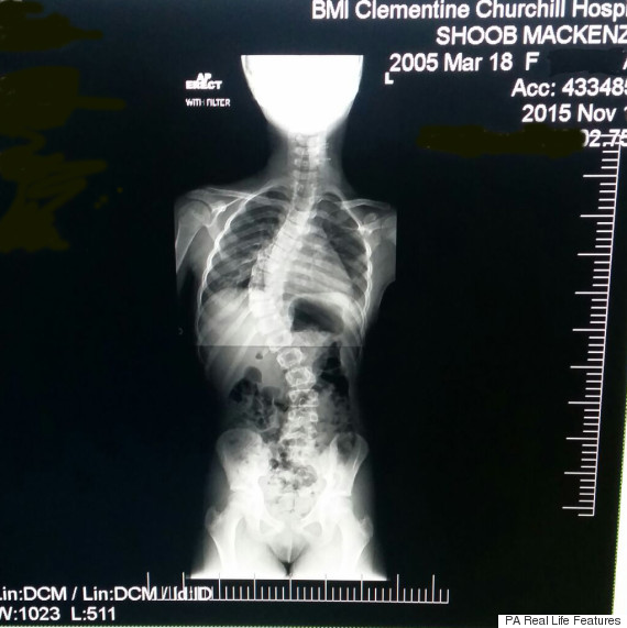 Mum's Shock After Daughter's 'Growing Pains' Turned Out To Be Her Spine ...