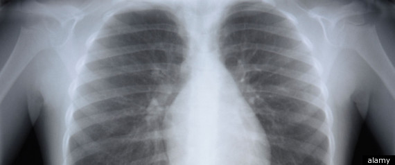 Ivacaftor, Cystic Fibrosis Drug, Shows Rapid Benefits