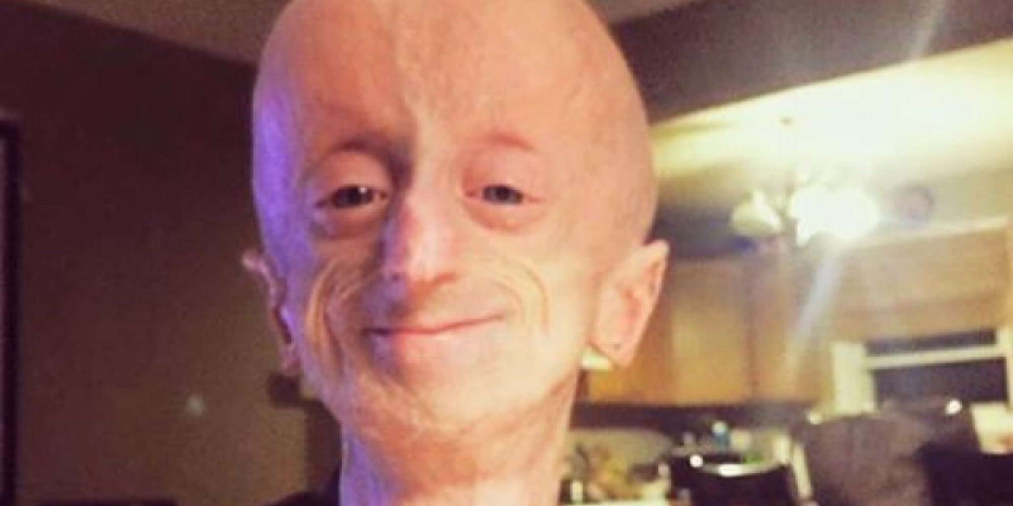 Devin Scullion, Hamilton Man With Rare Aging Disorder, Dies At Age 20