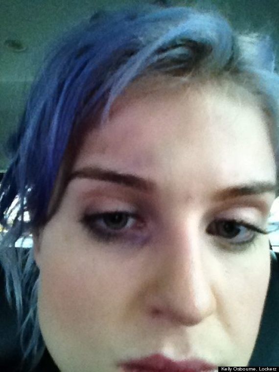 kelly osbourne black eye