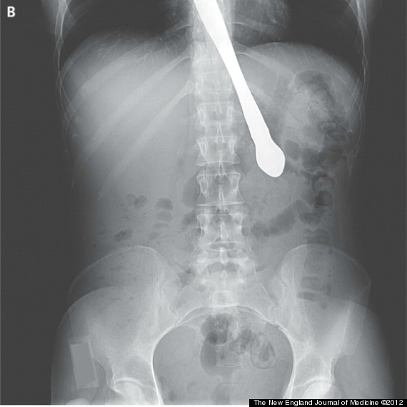 Woman Swallows Knife X Ray Images Show Cutlery Lodged In Atlanta Woman 