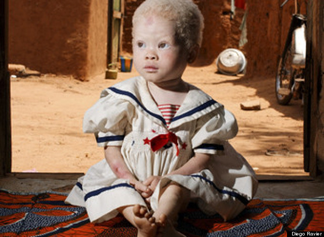 albinos