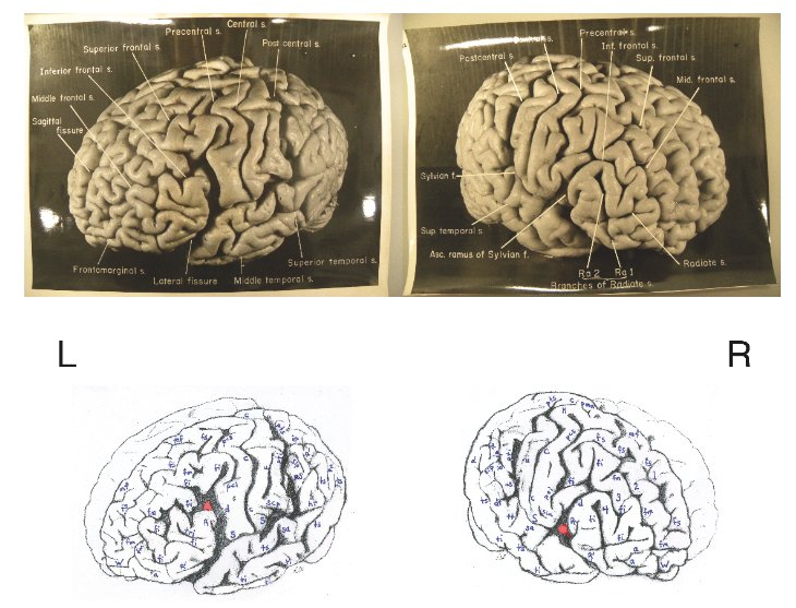 Genius Brain Vs Normal Brain