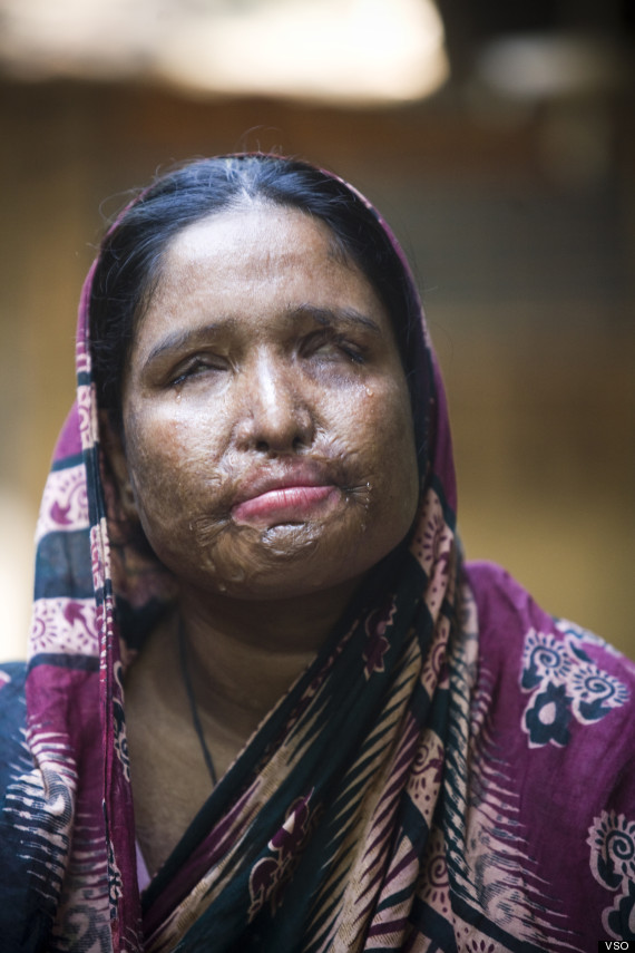 acid attack survivor