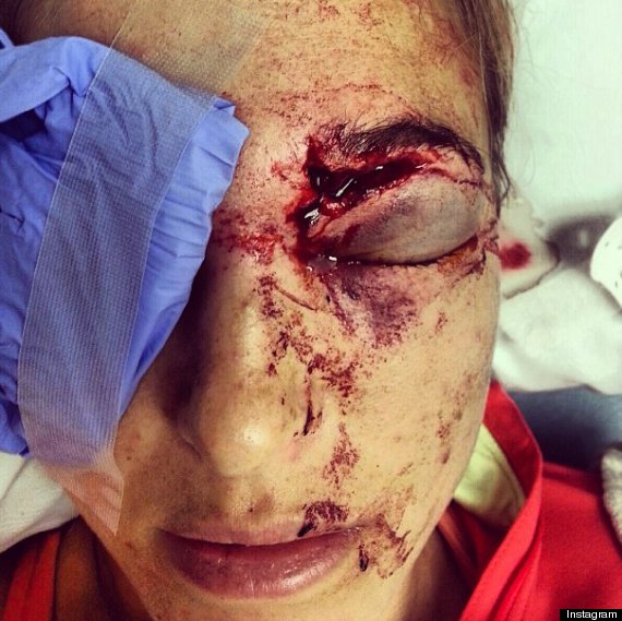 golf shot hits wife eye bode miller morgan beck